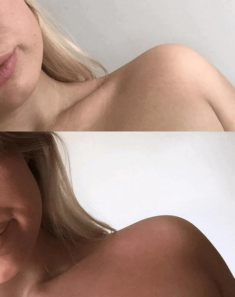 Hombro y cuello antes y después del bronceado